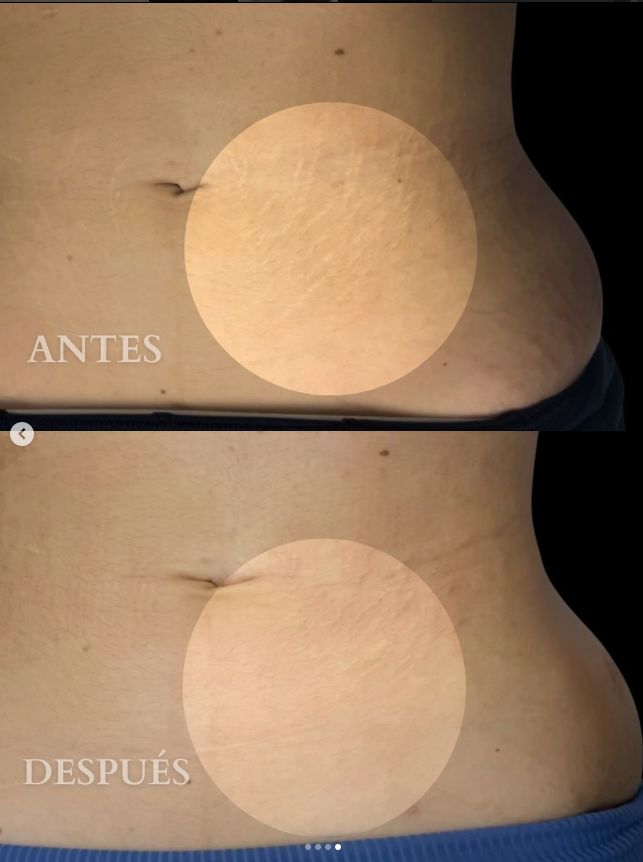 Caso real abdomen lateral