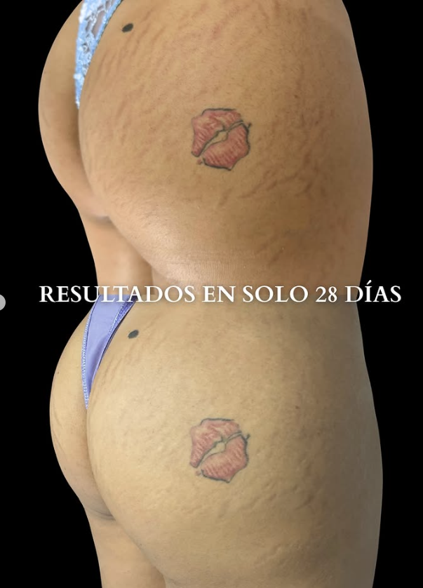 Caso real estrías